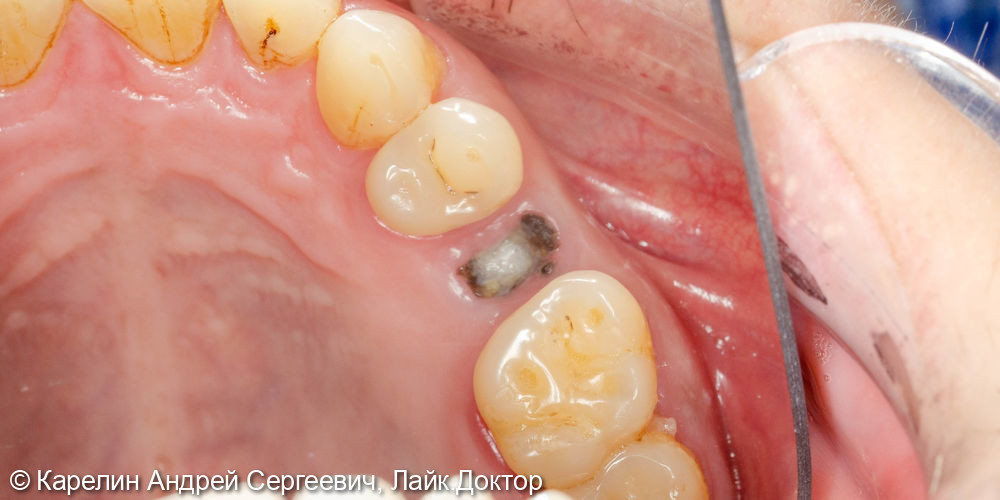 Имлантация 3 зубов - фото №2