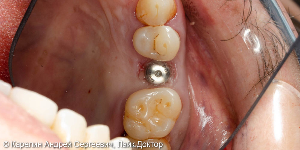 Имлантация 3 зубов - фото №4