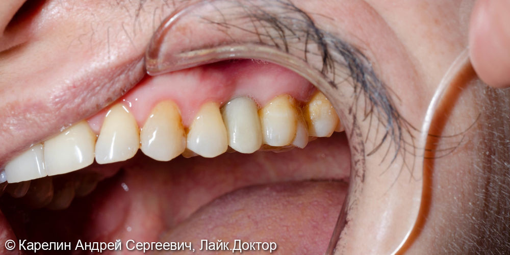 Имлантация 3 зубов - фото №6