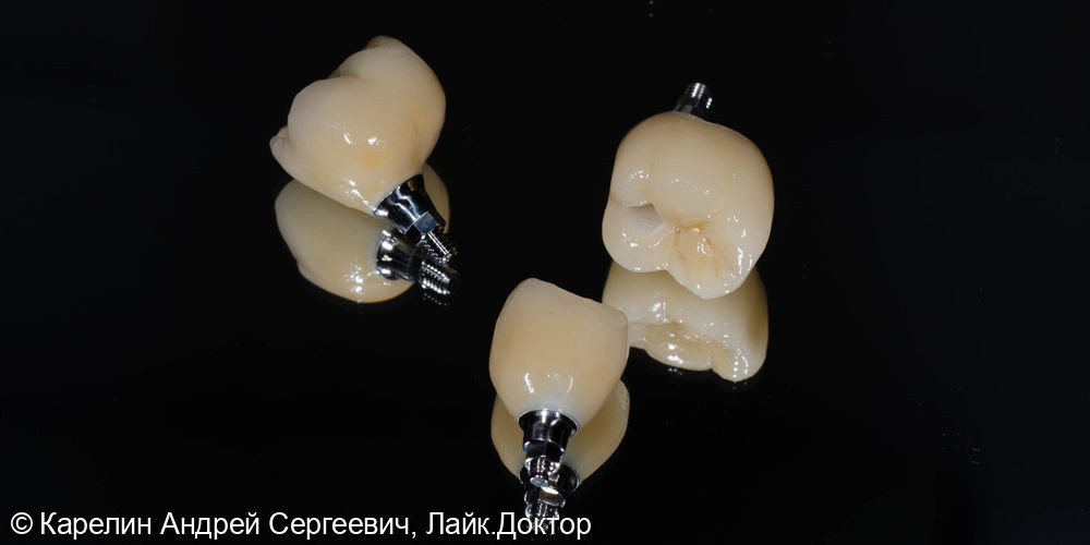 Имлантация 3 зубов - фото №10