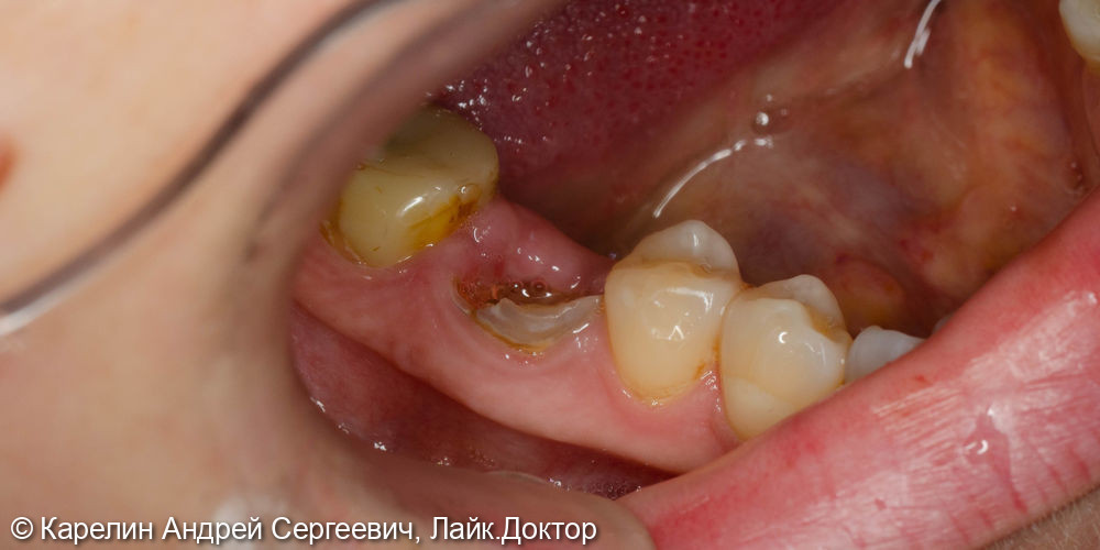 Одномоментная с удалением имплантация в области зуба 4.6 и полный протокол протезирования - фото №1