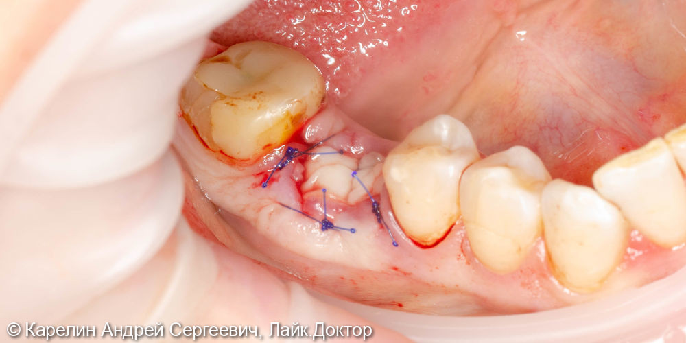 Одномоментная с удалением имплантация в области зуба 4.6 и полный протокол протезирования - фото №2
