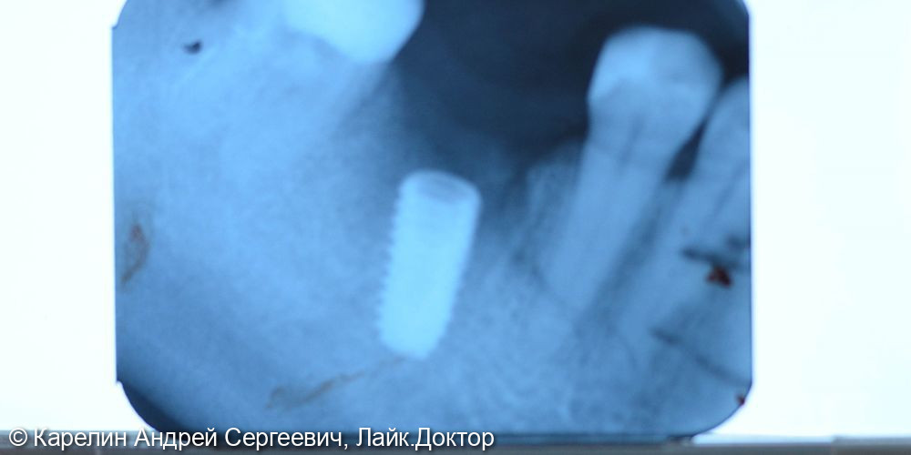 Одномоментная с удалением имплантация в области зуба 4.6 и полный протокол протезирования - фото №3