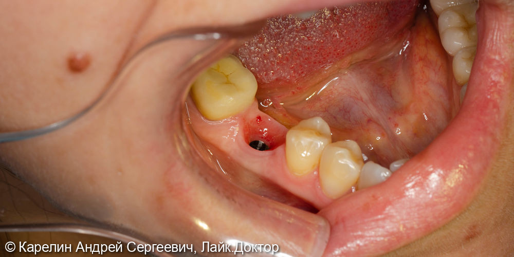 Одномоментная с удалением имплантация в области зуба 4.6 и полный протокол протезирования - фото №4