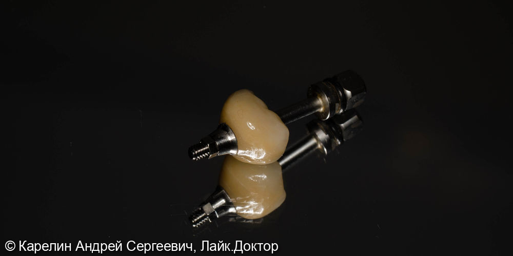 Одномоментная с удалением имплантация в области зуба 4.6 и полный протокол протезирования - фото №5