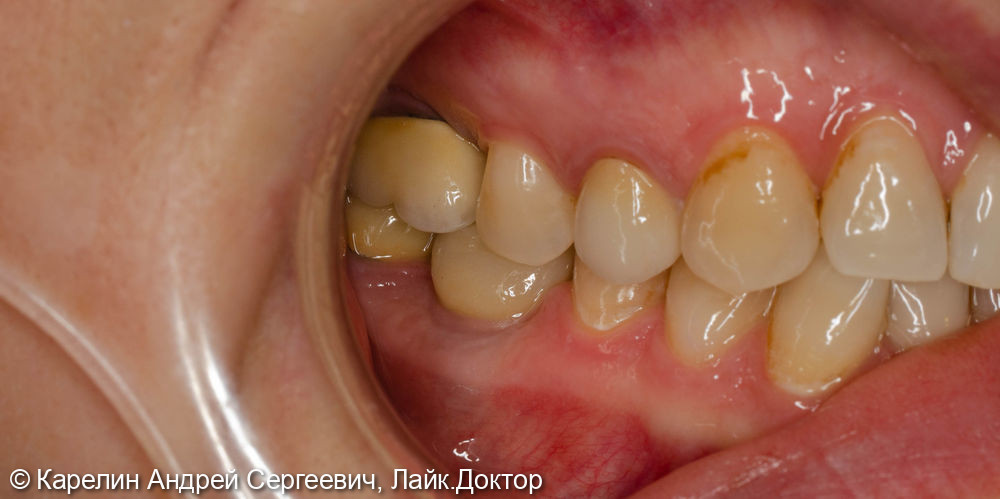 Одномоментная с удалением имплантация в области зуба 4.6 и полный протокол протезирования - фото №6
