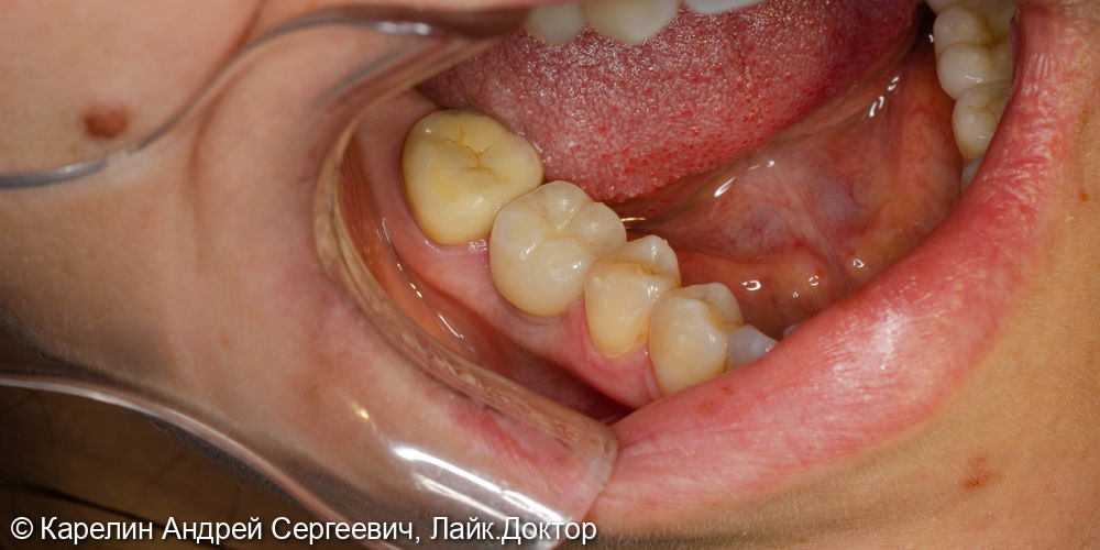 Одномоментная с удалением имплантация в области зуба 4.6 и полный протокол протезирования - фото №7