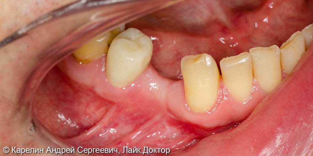 Имплантация в области зуба 4.4 с пластикой десны и протезированием.4.5 вкладка культевая и металлокерамическая коронка - фото №1