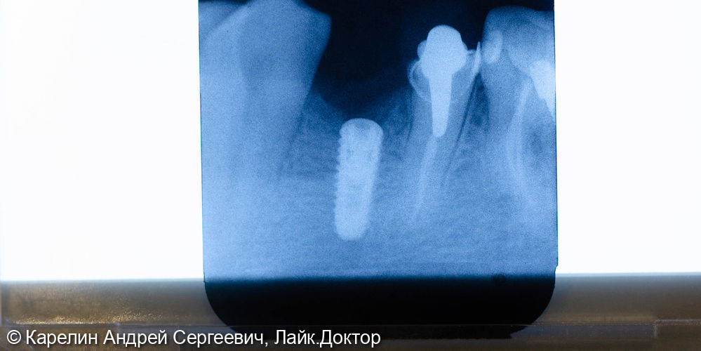 Имплантация в области зуба 4.4 с пластикой десны и протезированием.4.5 вкладка культевая и металлокерамическая коронка - фото №2