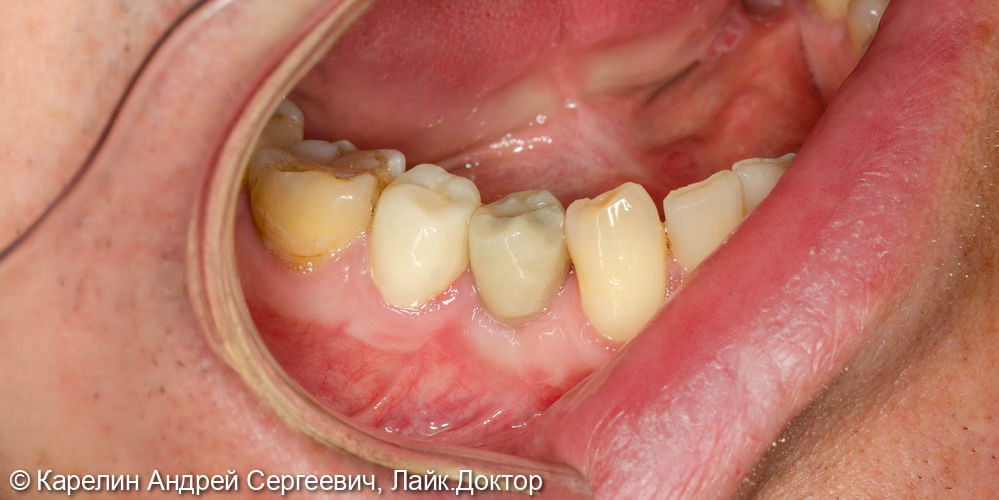 Имплантация в области зуба 4.4 с пластикой десны и протезированием.4.5 вкладка культевая и металлокерамическая коронка - фото №3