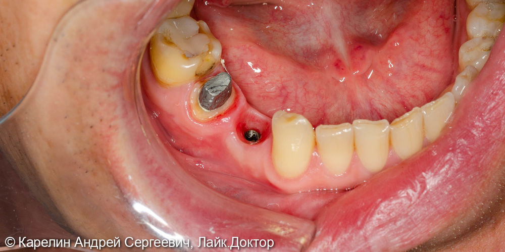 Имплантация в области зуба 4.4 с пластикой десны и протезированием.4.5 вкладка культевая и металлокерамическая коронка - фото №5