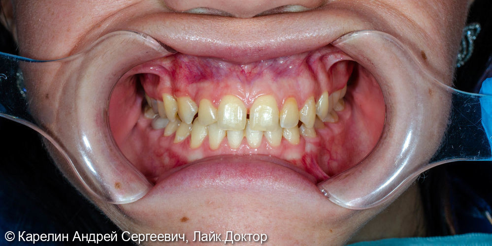 Виниры после ортодонтического лечения - фото №2