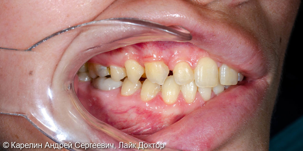 Виниры после ортодонтического лечения - фото №3
