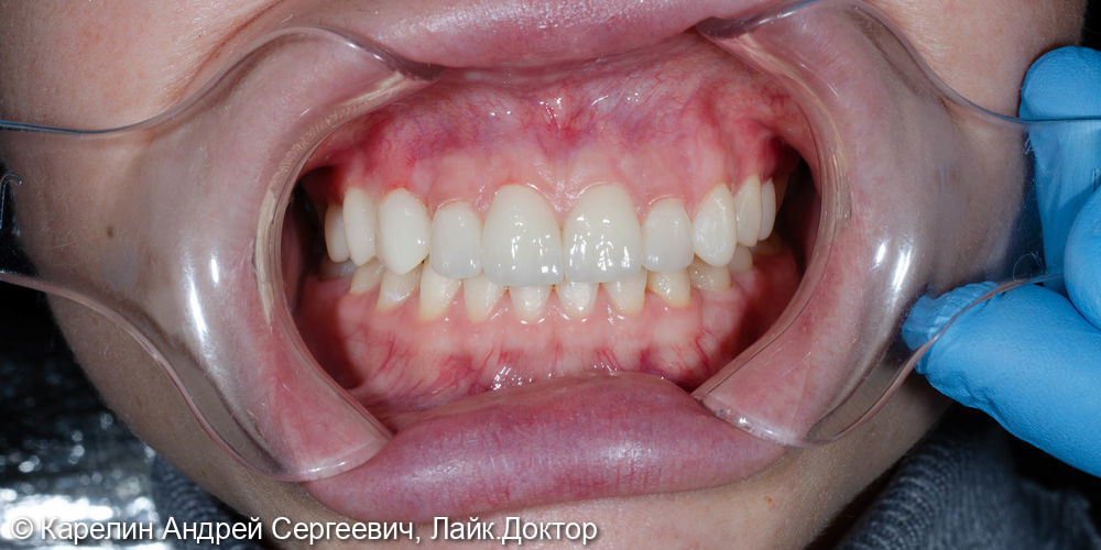 Виниры после ортодонтического лечения - фото №7