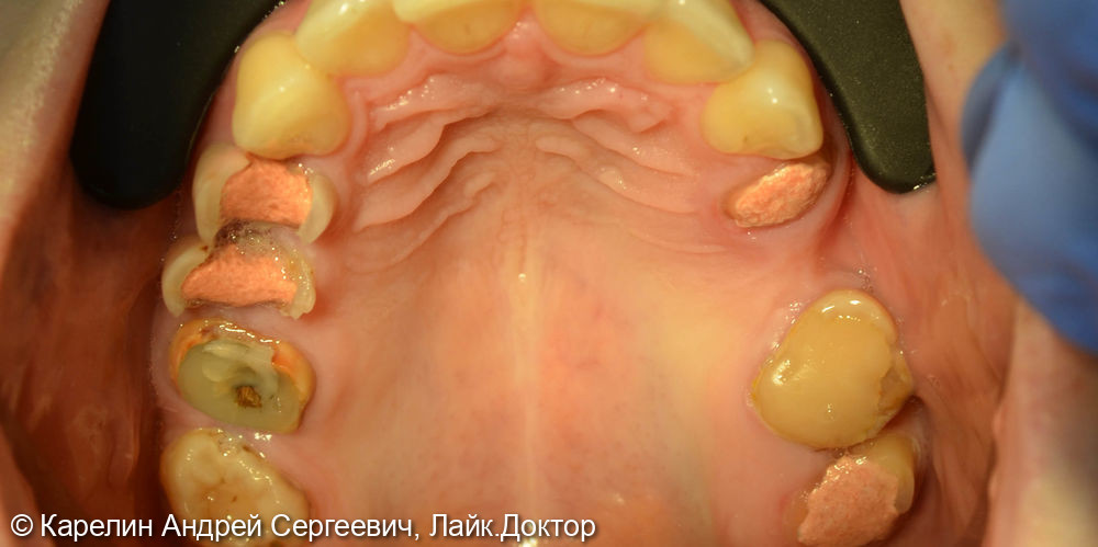 Полная реконструкция обеих челюстей с помощью брекет систем, имплантатов и коронок - фото №4