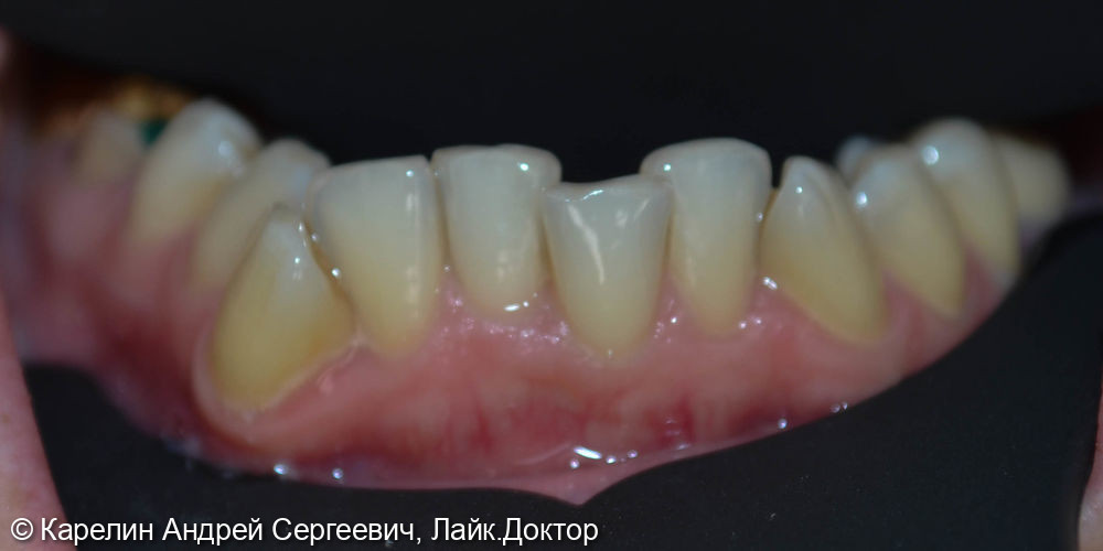 Полная реконструкция обеих челюстей с помощью брекет систем, имплантатов и коронок - фото №6