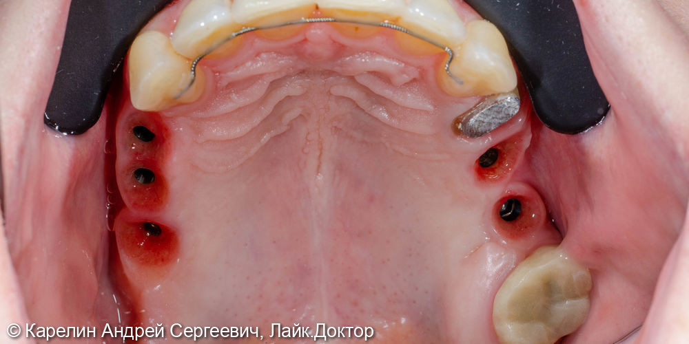 Полная реконструкция обеих челюстей с помощью брекет систем, имплантатов и коронок - фото №7