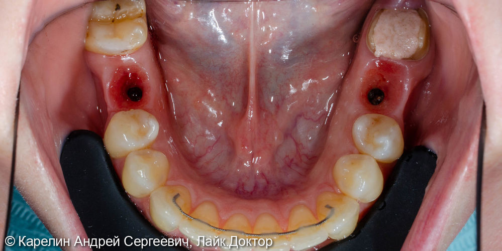 Полная реконструкция обеих челюстей с помощью брекет систем, имплантатов и коронок - фото №8
