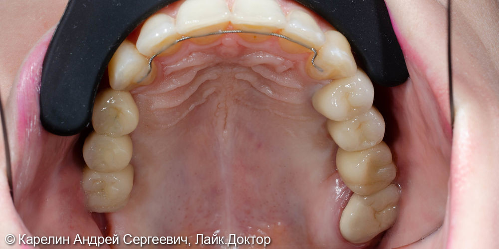 Полная реконструкция обеих челюстей с помощью брекет систем, имплантатов и коронок - фото №9
