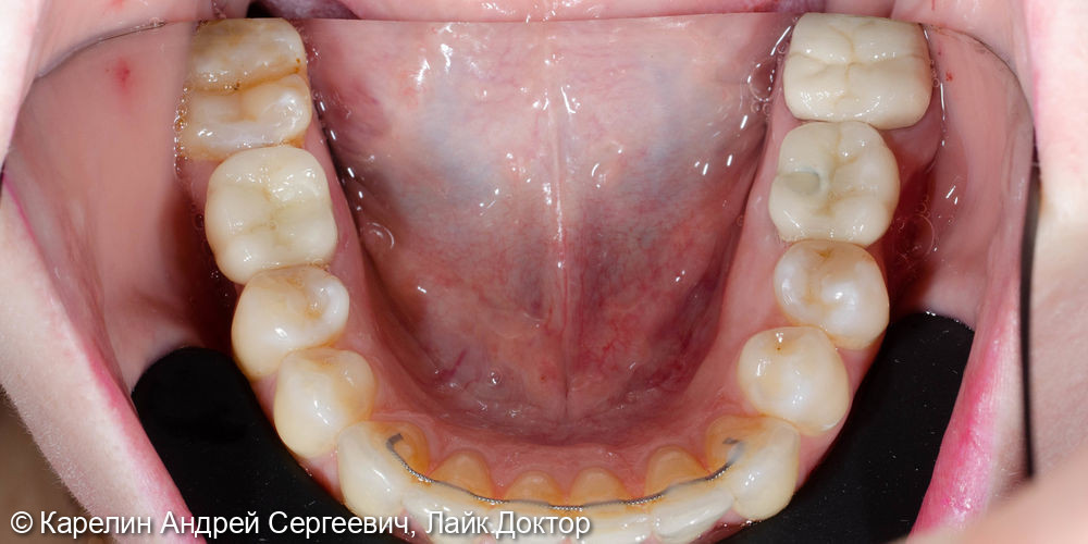 Полная реконструкция обеих челюстей с помощью брекет систем, имплантатов и коронок - фото №10