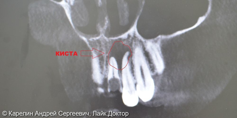 Имплантация в области центрального резца - фото №2