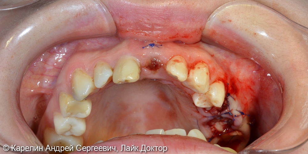 Имплантация в области центрального резца - фото №5