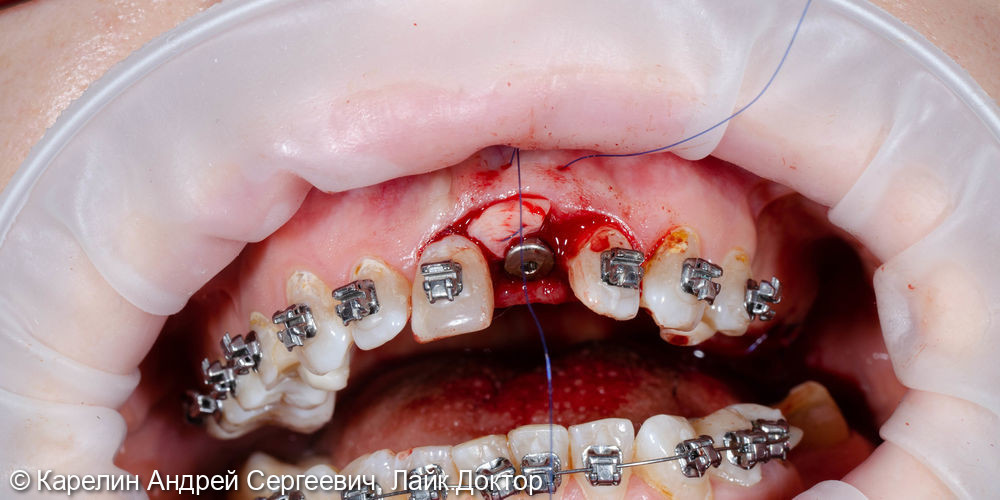 Имплантация в области центрального резца - фото №11
