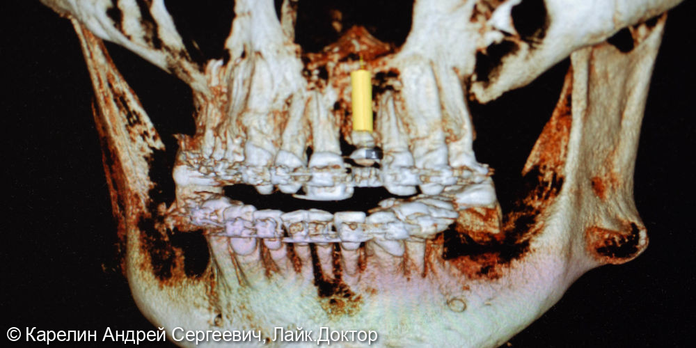 Имплантация в области центрального резца - фото №13