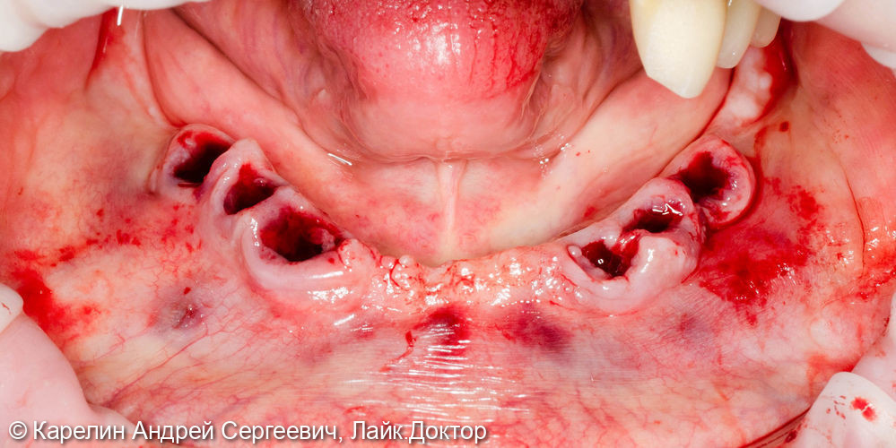 Установка 4 имплантатов на нижнюю челюсть под бюгельный протез с балочной фиксацией - фото №3
