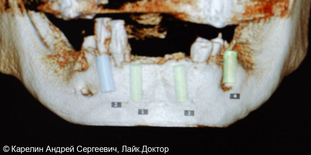 Установка 4 имплантатов на нижнюю челюсть под бюгельный протез с балочной фиксацией - фото №5