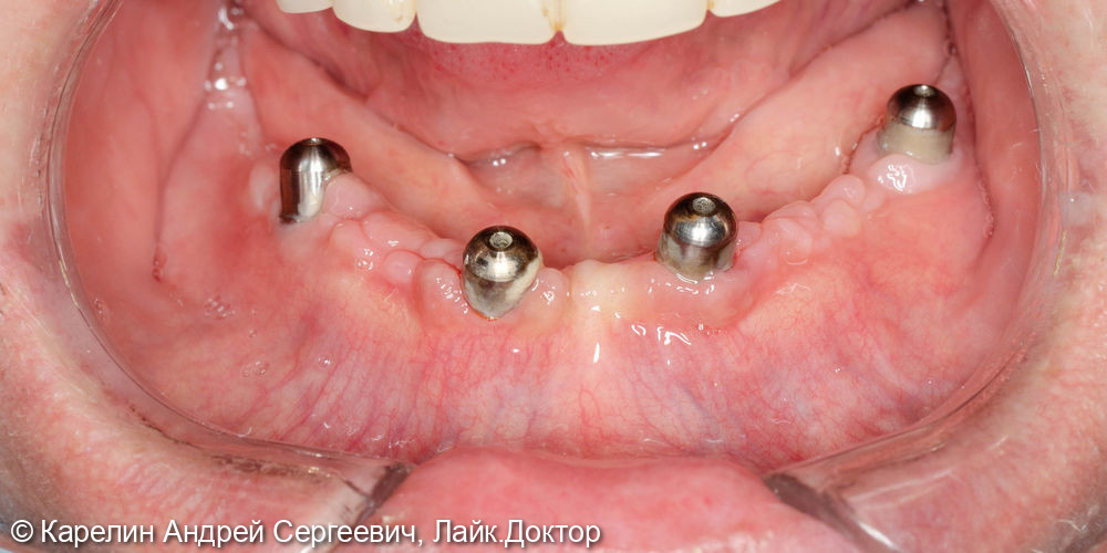 Установка 4 имплантатов на нижнюю челюсть под бюгельный протез с балочной фиксацией - фото №6