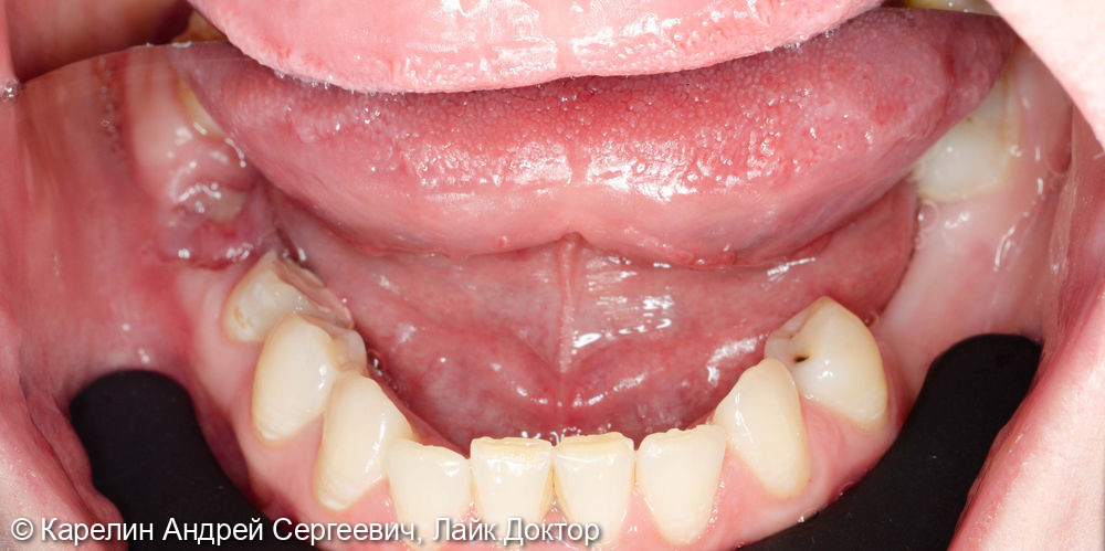 Восстановление жевательных зубов с помощью имплантатов - фото №1