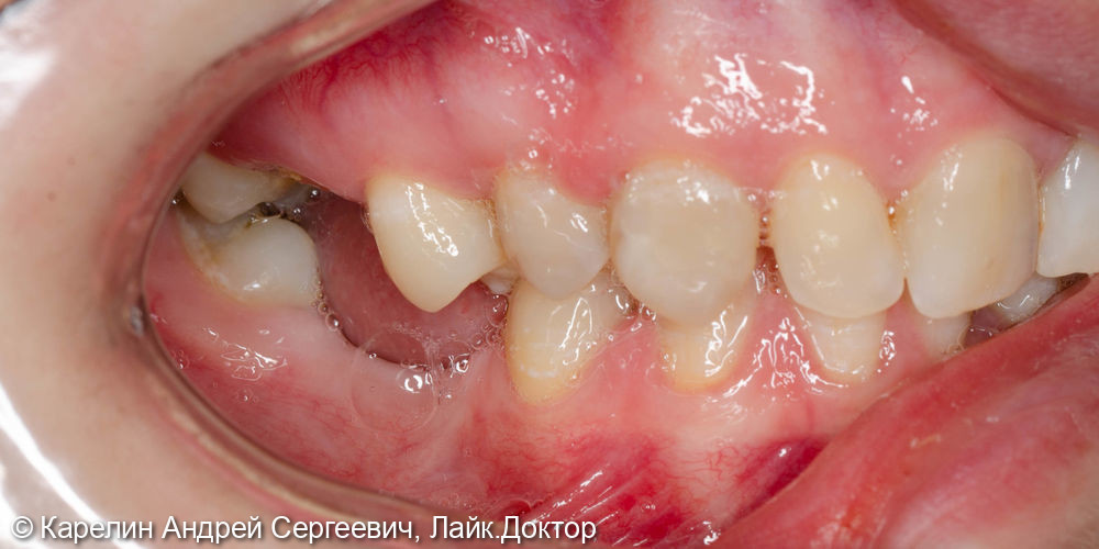Восстановление жевательных зубов с помощью имплантатов - фото №2