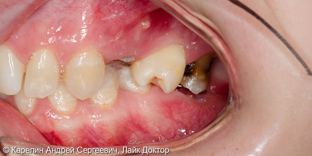 Восстановление жевательных зубов с помощью имплантатов - фото №3