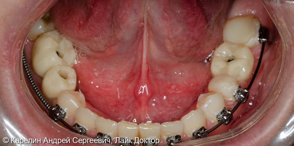 Восстановление жевательных зубов с помощью имплантатов - фото №4