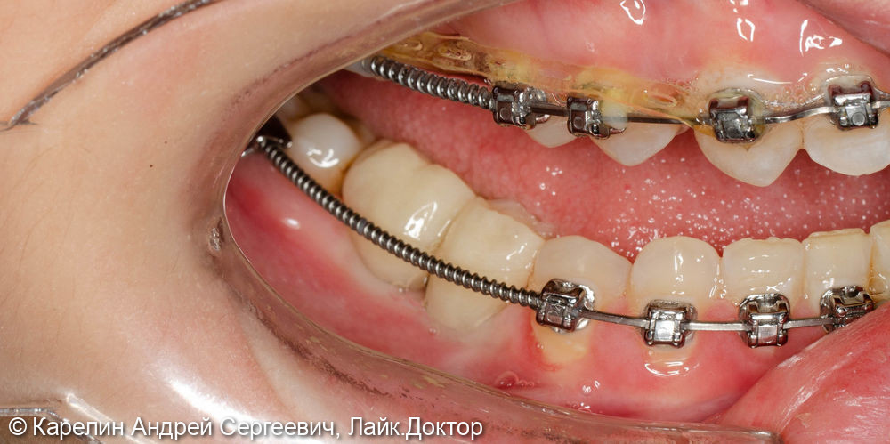 Восстановление жевательных зубов с помощью имплантатов - фото №5