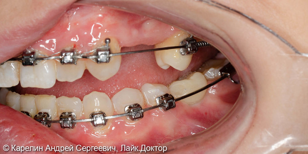 Восстановление жевательных зубов с помощью имплантатов - фото №6