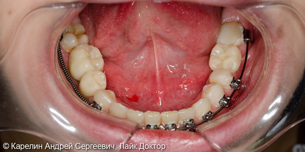 Восстановление жевательных зубов с помощью имплантатов - фото №7