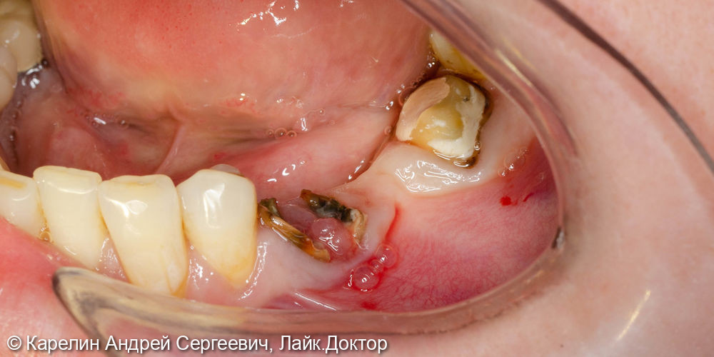 Имплантатция с костной пластикой и пластикой слизистой в области зубов 3.5 и 3.6 - фото №1