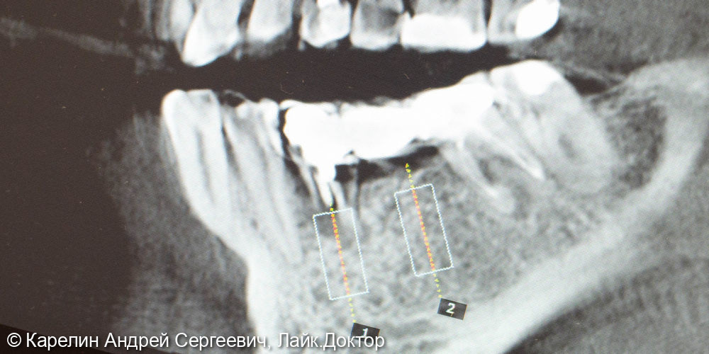 Имплантатция с костной пластикой и пластикой слизистой в области зубов 3.5 и 3.6 - фото №2