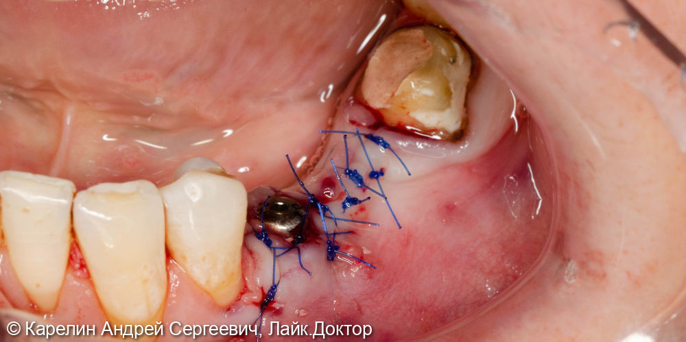 Имплантатция с костной пластикой и пластикой слизистой в области зубов 3.5 и 3.6 - фото №3