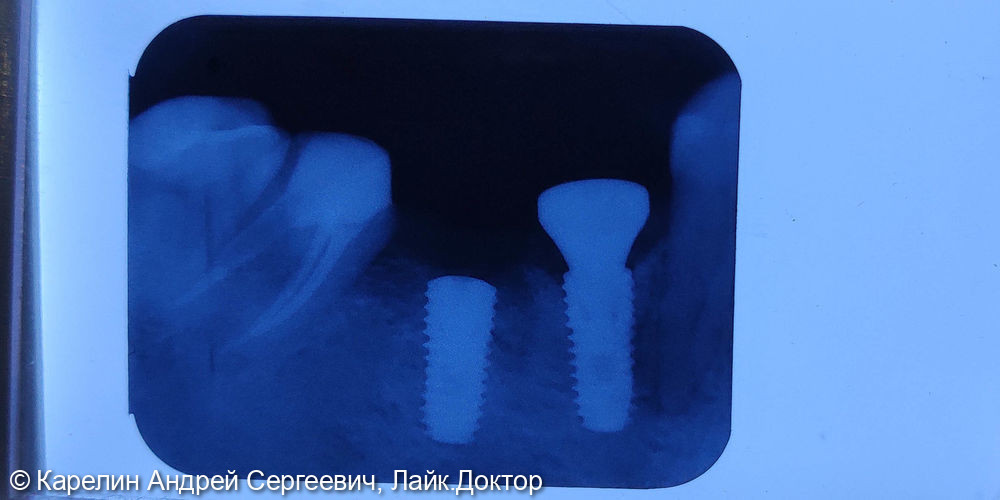 Имплантатция с костной пластикой и пластикой слизистой в области зубов 3.5 и 3.6 - фото №4