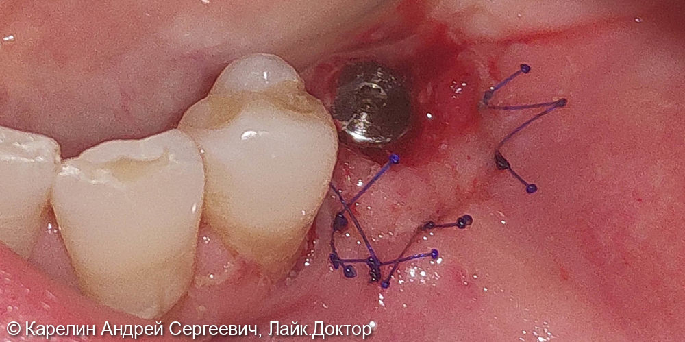 Имплантатция с костной пластикой и пластикой слизистой в области зубов 3.5 и 3.6 - фото №6