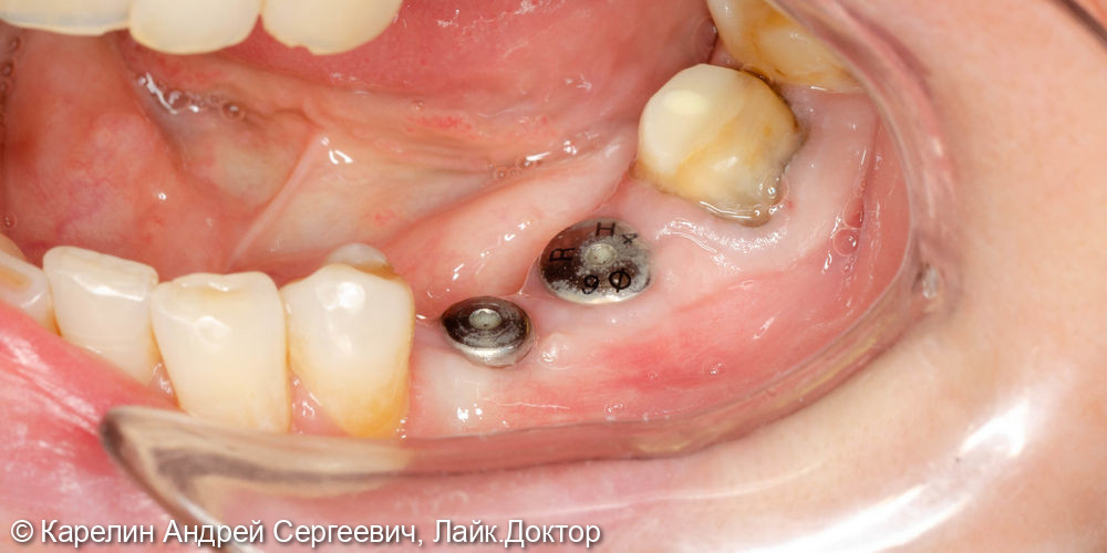 Имплантатция с костной пластикой и пластикой слизистой в области зубов 3.5 и 3.6 - фото №7