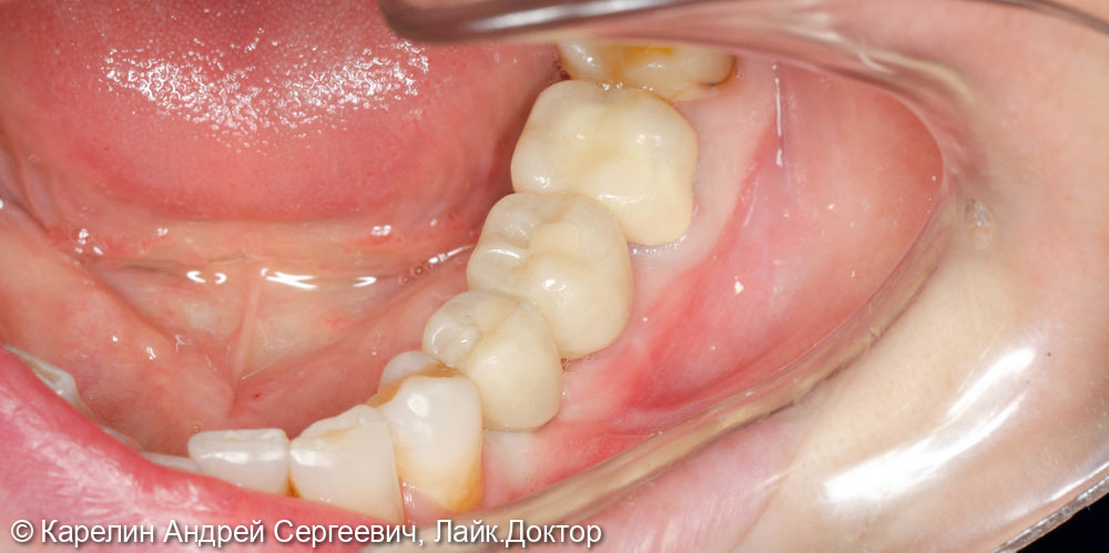 Имплантатция с костной пластикой и пластикой слизистой в области зубов 3.5 и 3.6 - фото №8