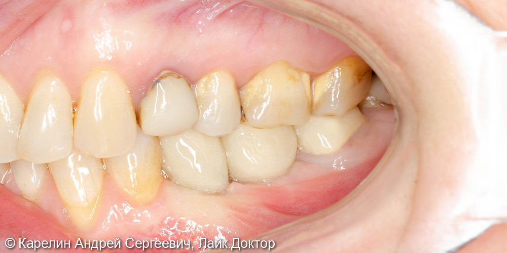 Имплантатция с костной пластикой и пластикой слизистой в области зубов 3.5 и 3.6 - фото №9