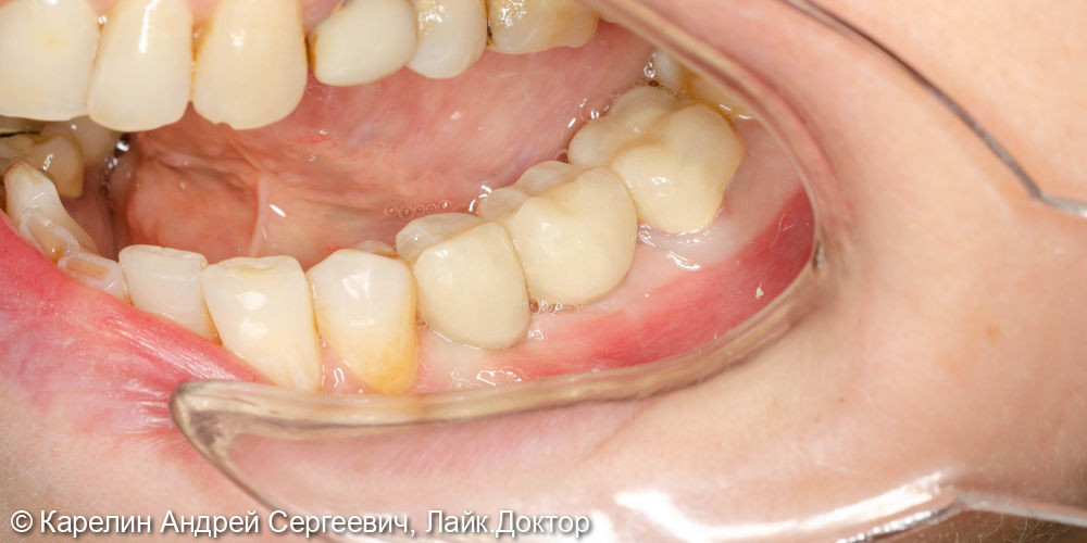 Имплантатция с костной пластикой и пластикой слизистой в области зубов 3.5 и 3.6 - фото №10