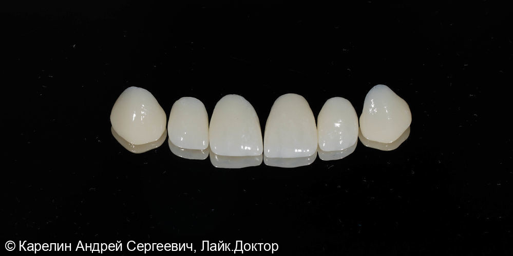 Керамические реставрации на верхнюю челюсть 1.3-2.3 (виниры) - фото №7