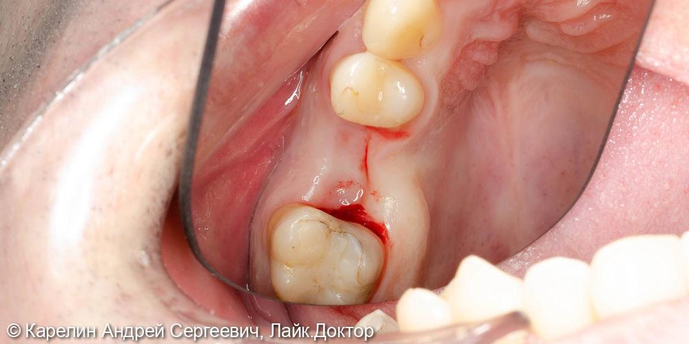 Имплантация в области зуба 2.6 - фото №1