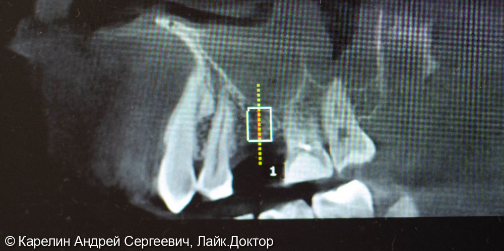 Имплантация в области зуба 2.6 - фото №2